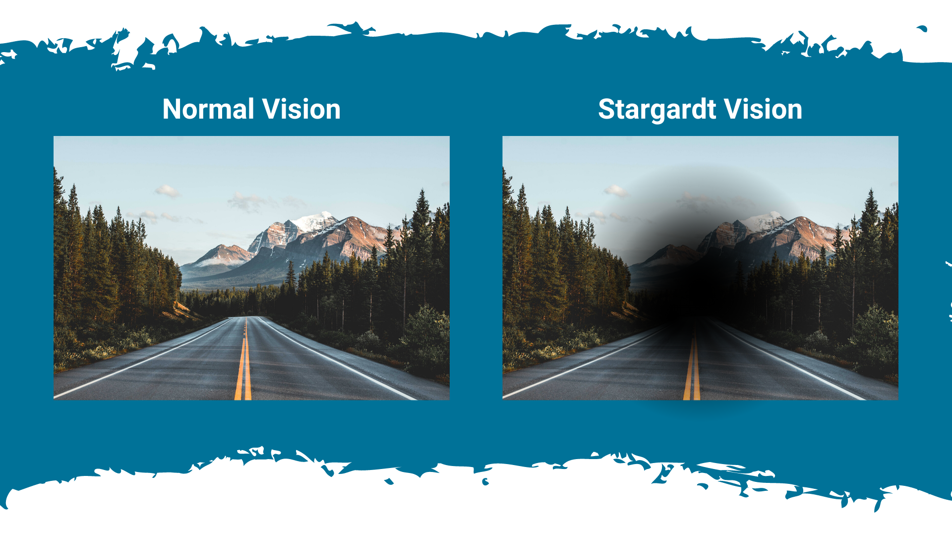 Normal vision vs. Stargardt vision