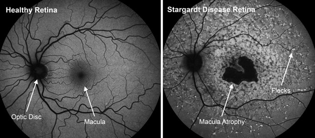 Healthy retina vs. Stargardt disease retina